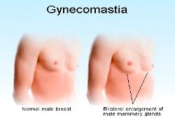 Gynecomastia a prostatitis alatt
